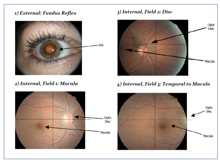 Стандартные форматы изображений для диабетической ретинопатии (правый глаз). Источник: EYEPACS LLC 2017